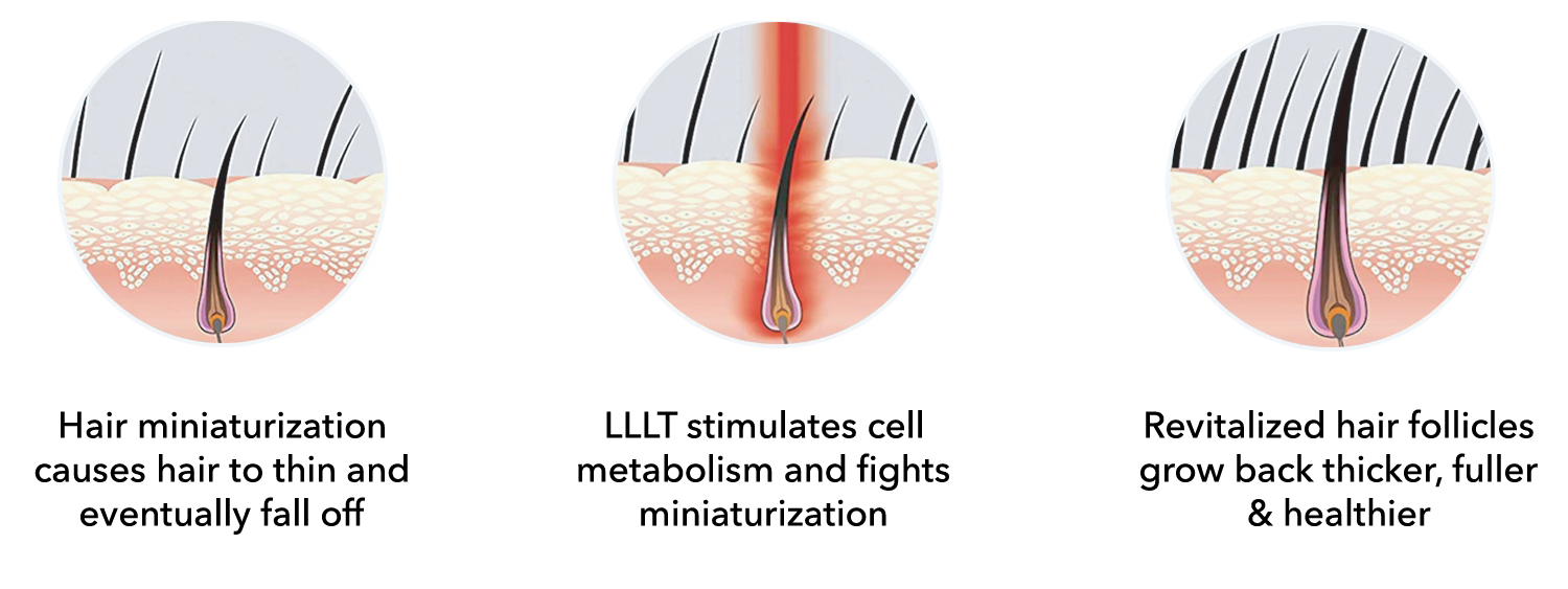 hairsmart LLLT diagram