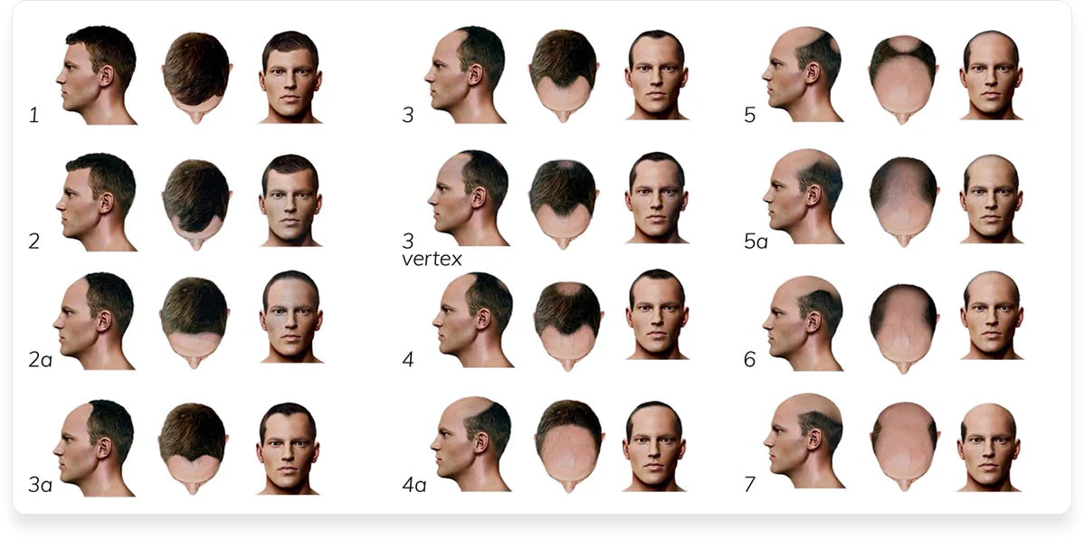 know hair loss stages with hairsmart