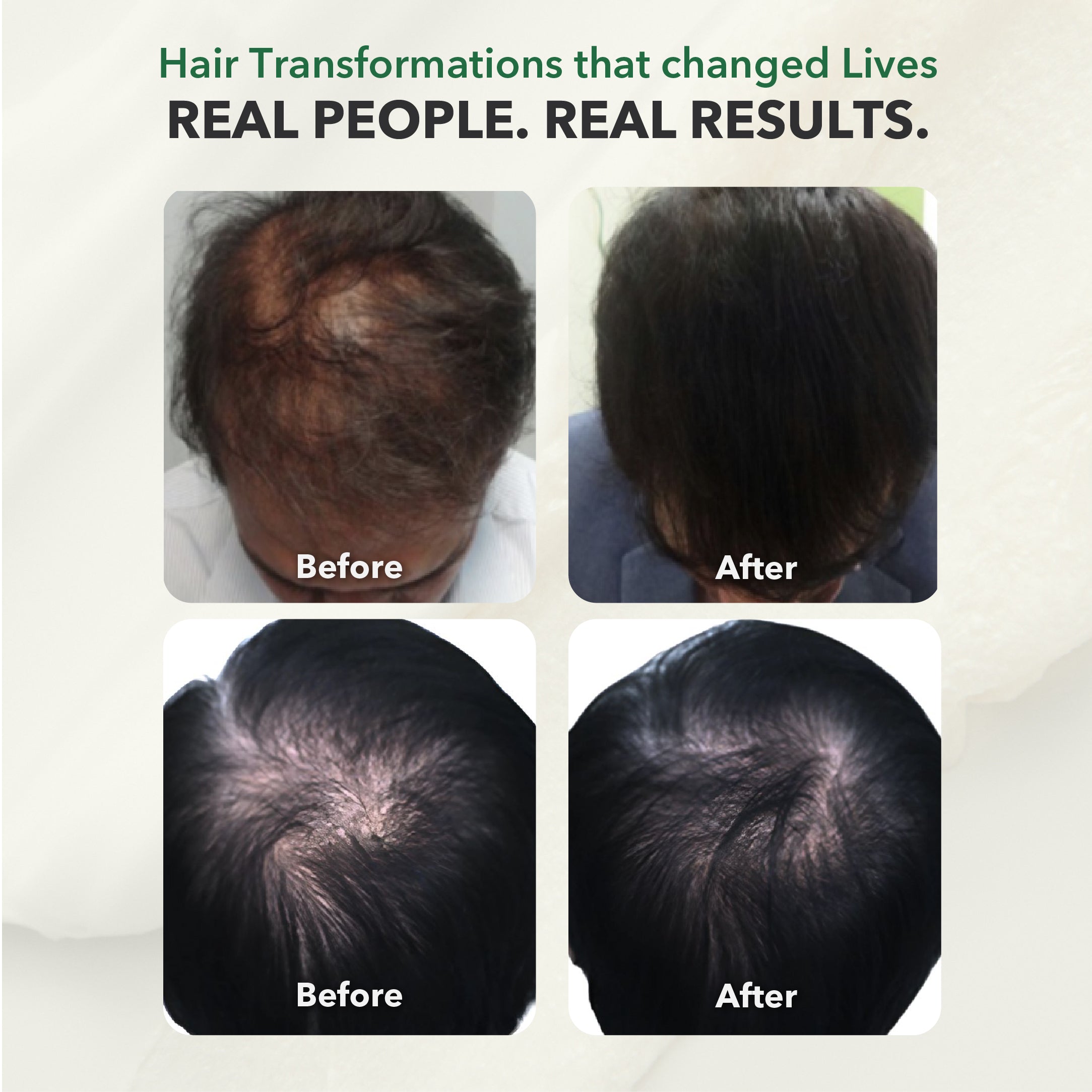 100% Natural DHT BLOCKER for Genetic Hair Loss in Men & Women; 60 Capsules