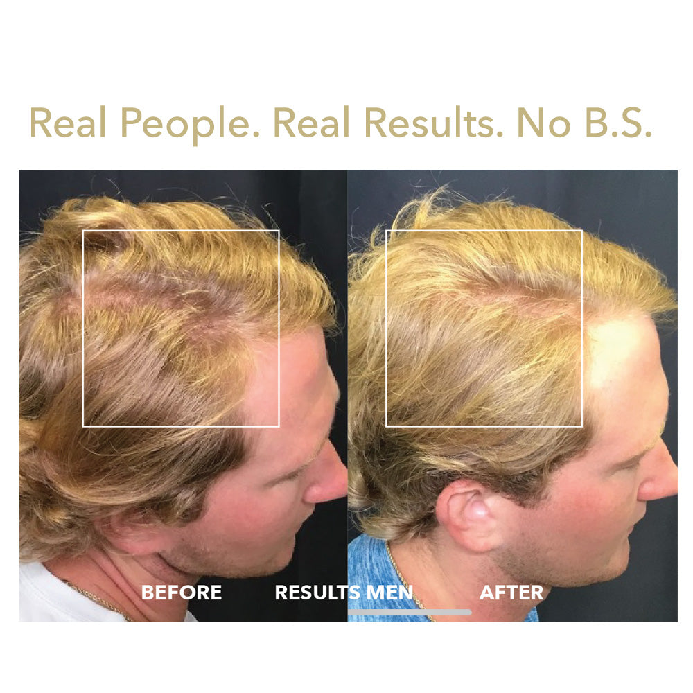 HairSmart before after with laser hair regrowth cap