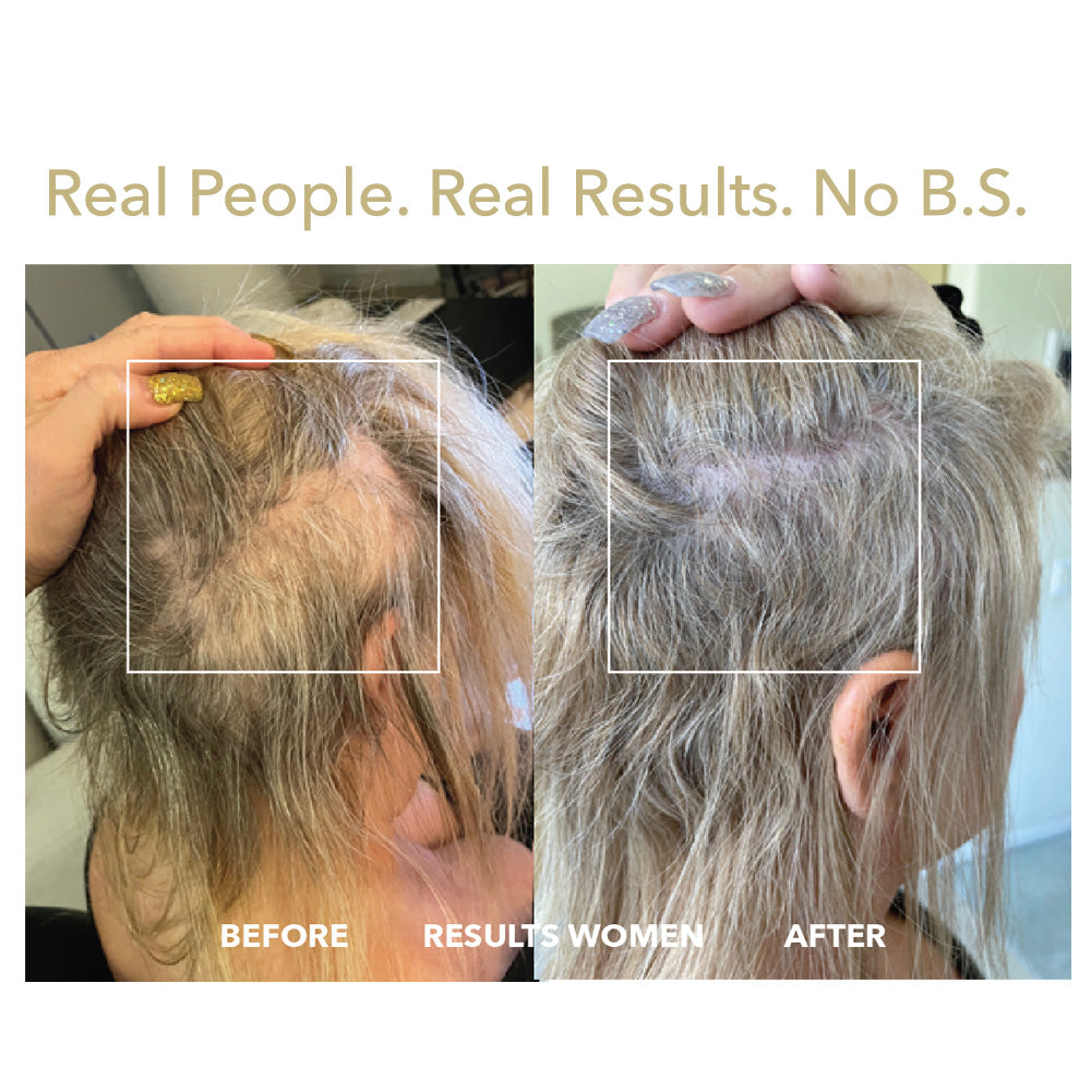 HairSmart before after with laser hair regrowth cap