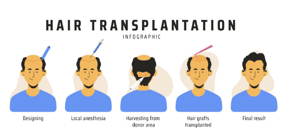 The Complete Guide: Maximizing Your Results After Hair Transplant Surgery