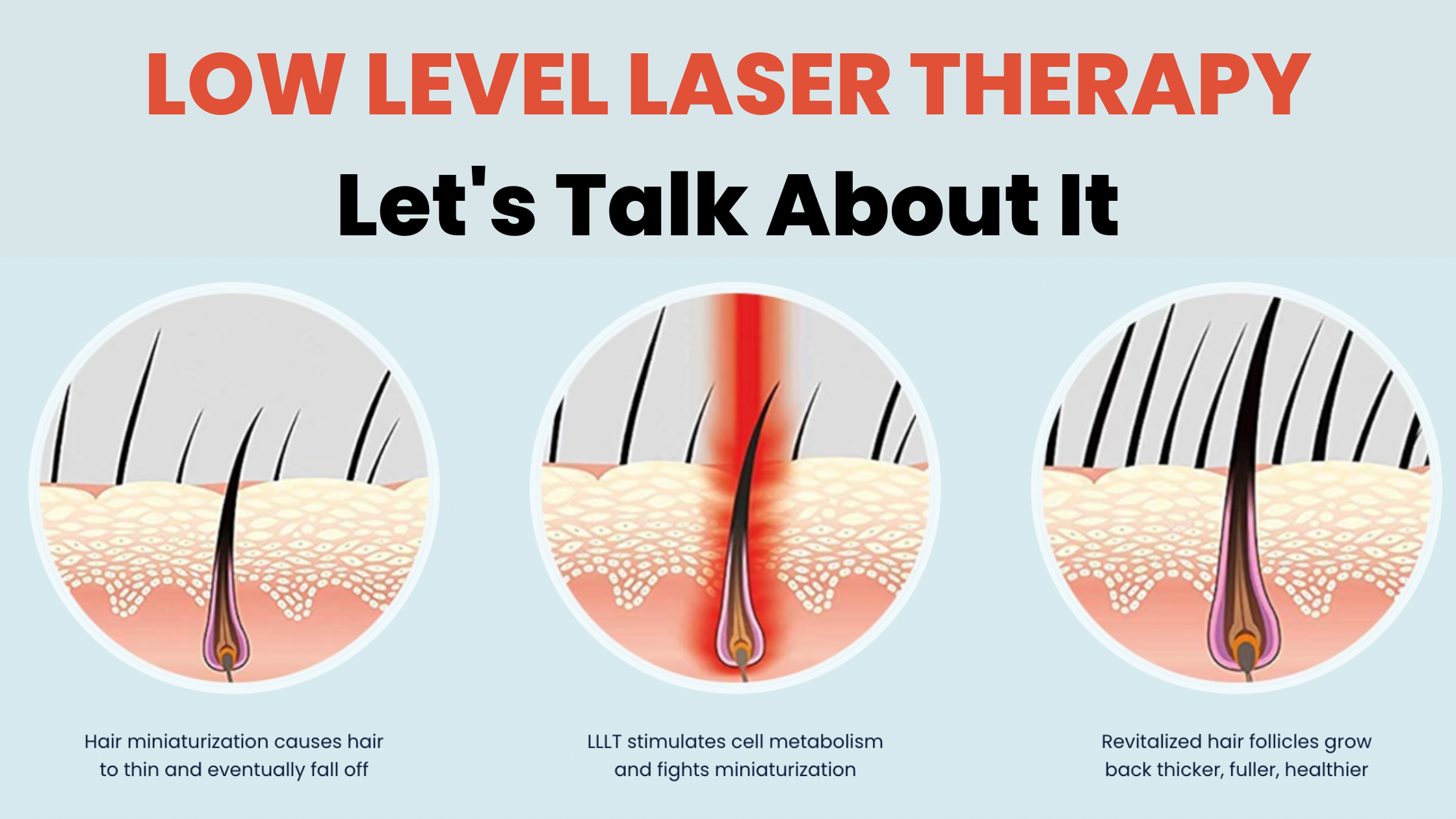Low Level Laser Therapy - The Complete Solution for Hair Loss and Balding - MyHairSmart
