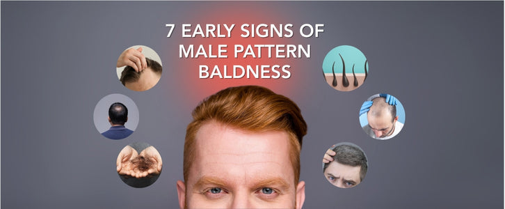 7 Early Signs of Male Pattern Baldness & How to Stop It