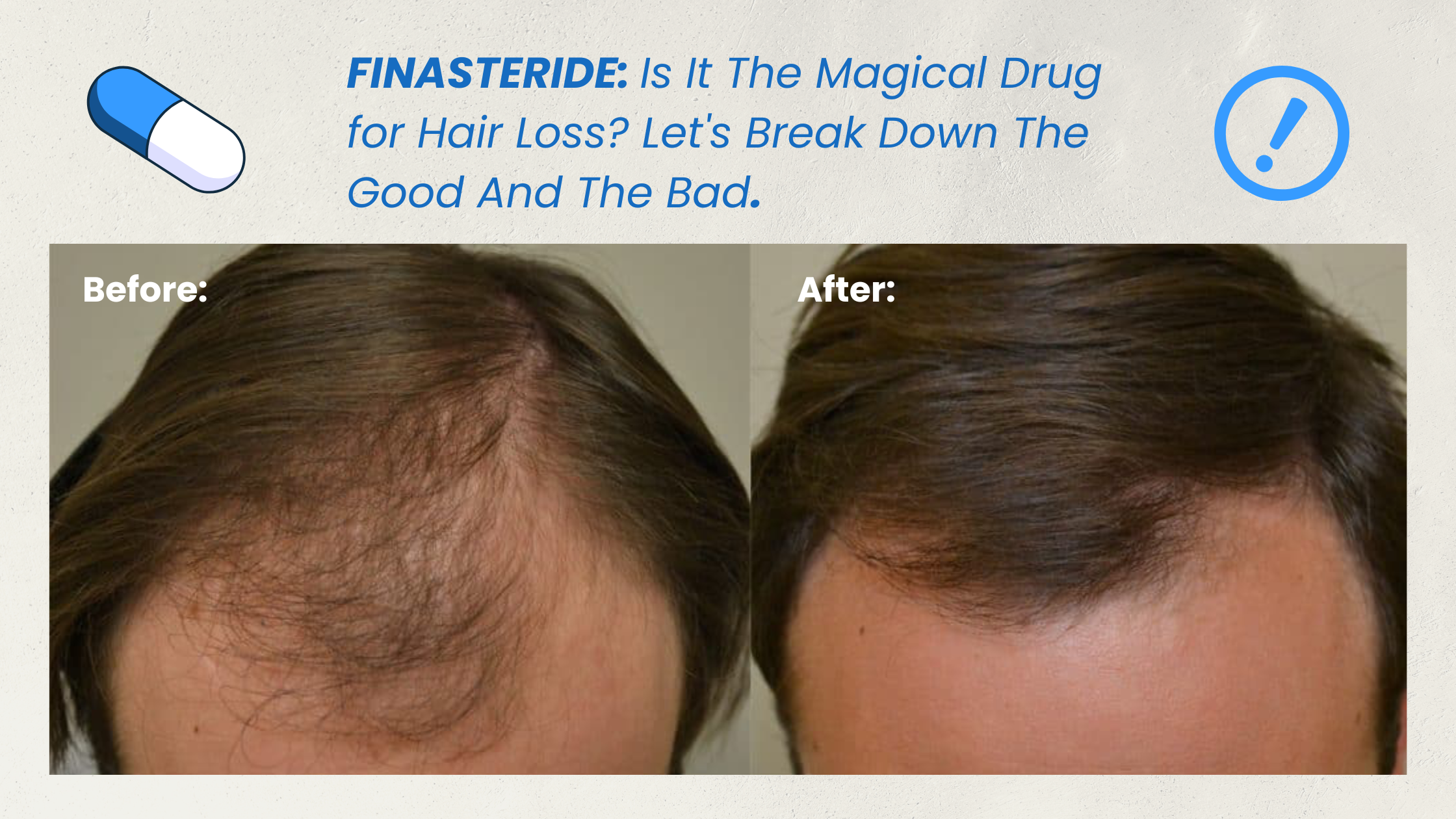 Finasteride and Hair Health