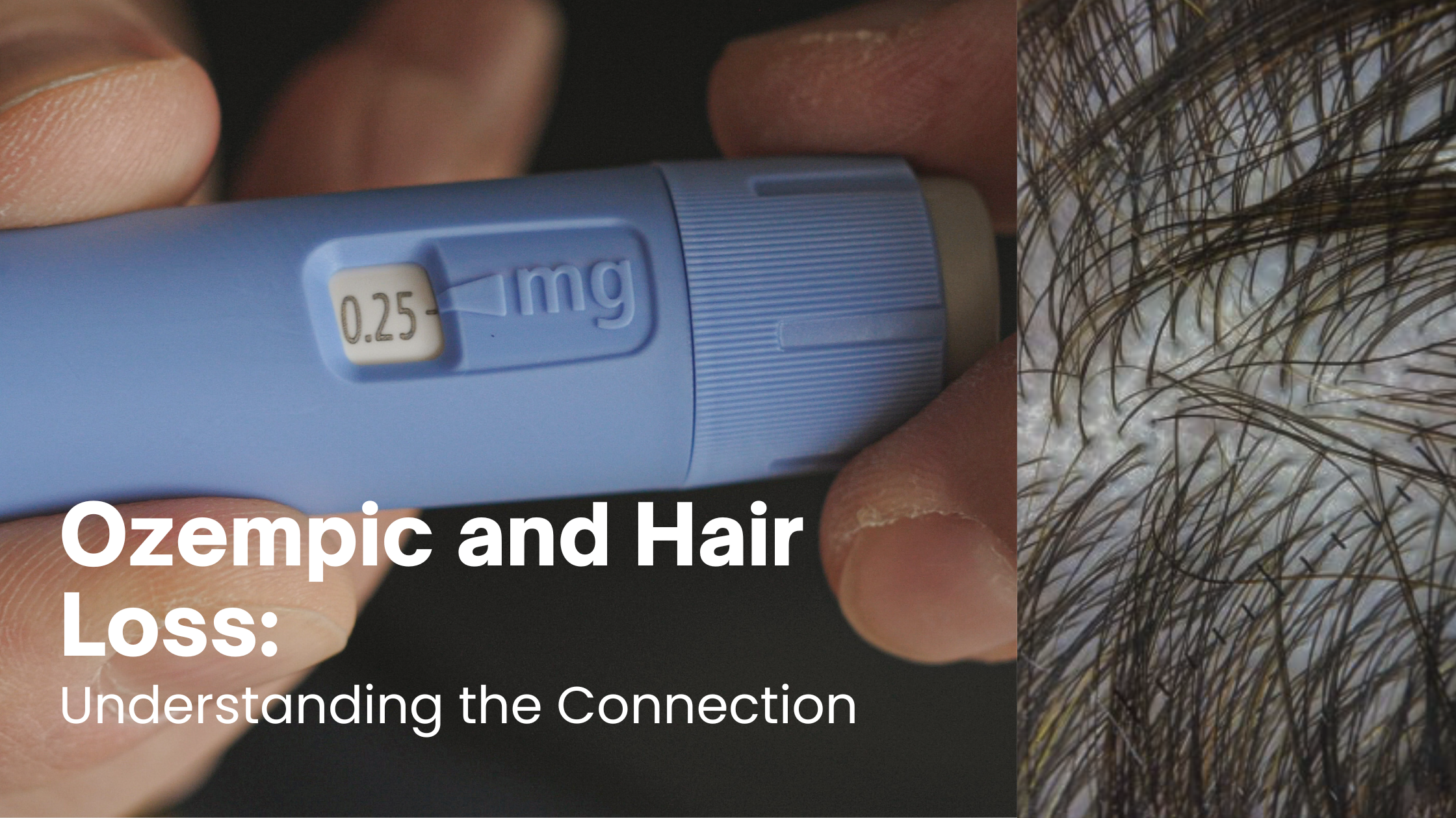 ozempic and hair loss