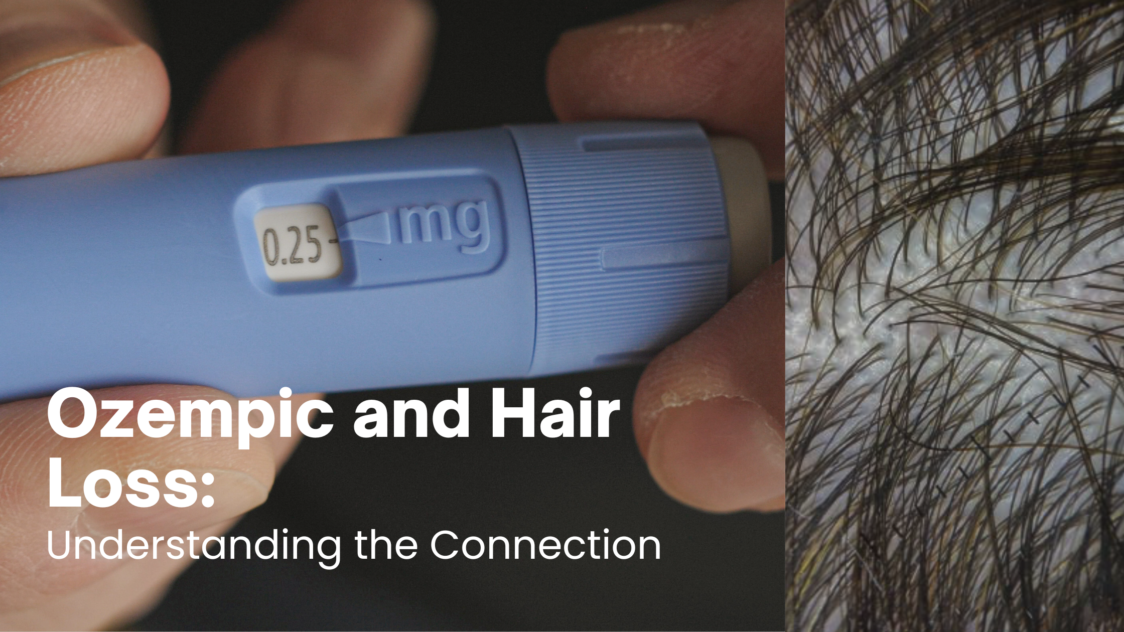 Ozempic and Hair Loss: Understanding the Connection
