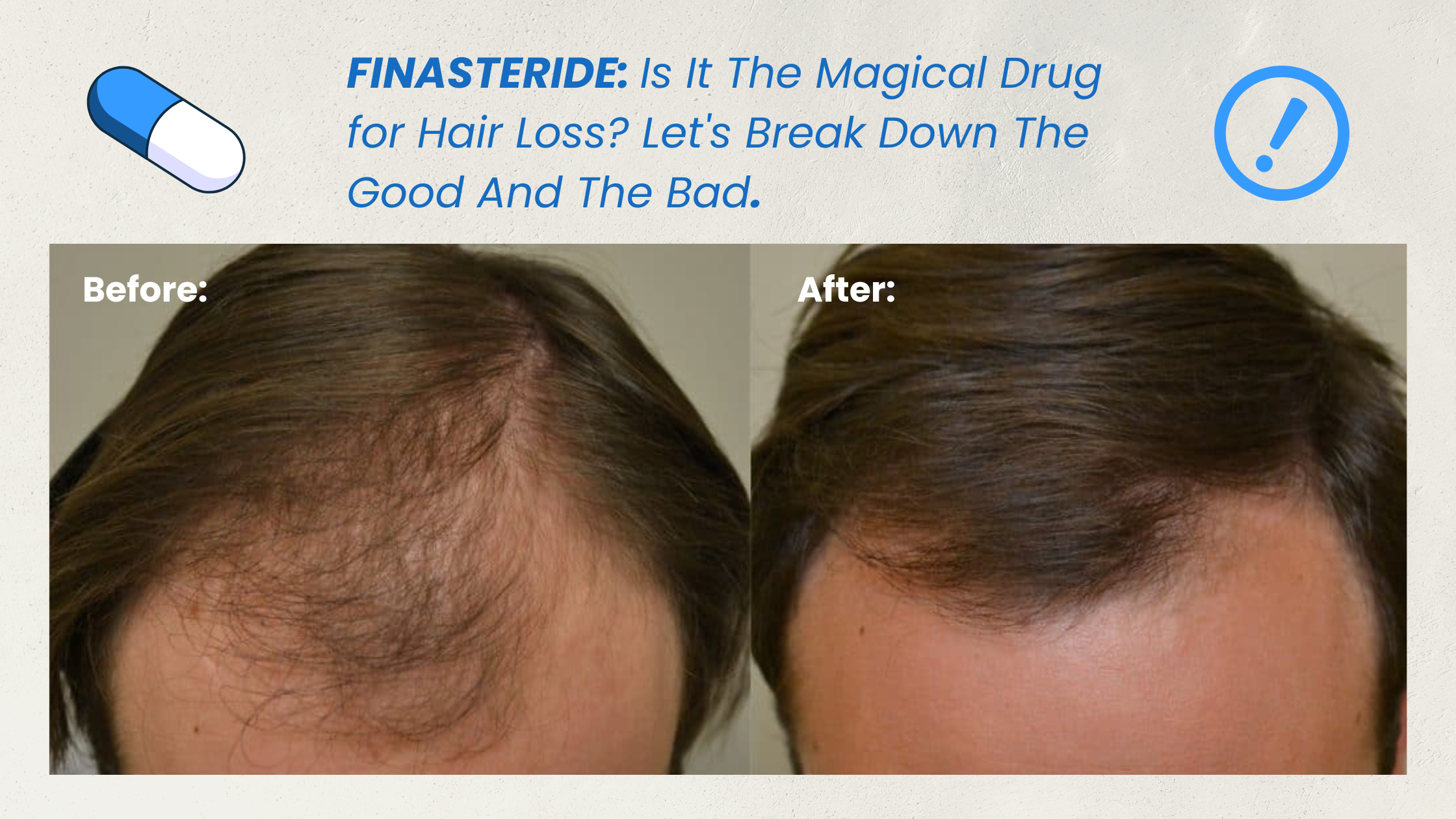 Finasteride: Is It The Magical Drug for Hair Loss? Let's Break Down The Good And The Bad.