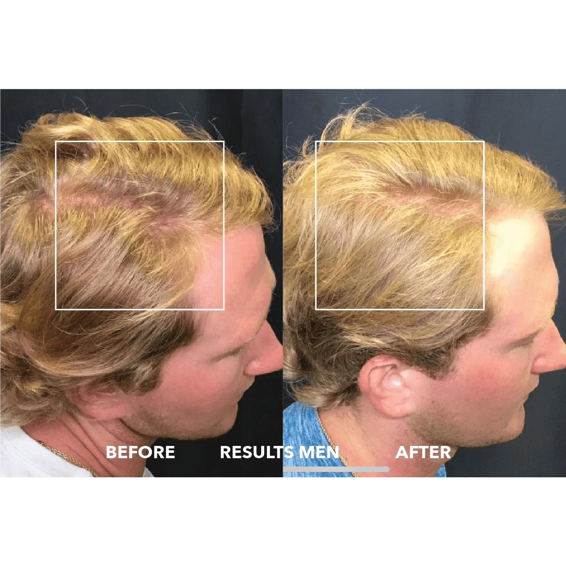 GrowthX : Advanced Clinically-proven hair regrowth for men & women