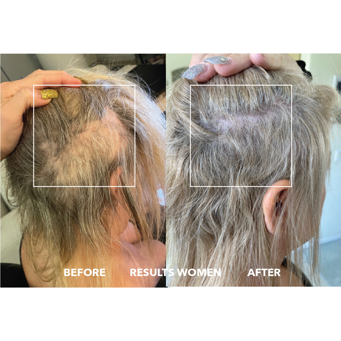 GrowthX : Advanced Clinically-proven hair regrowth for men & women