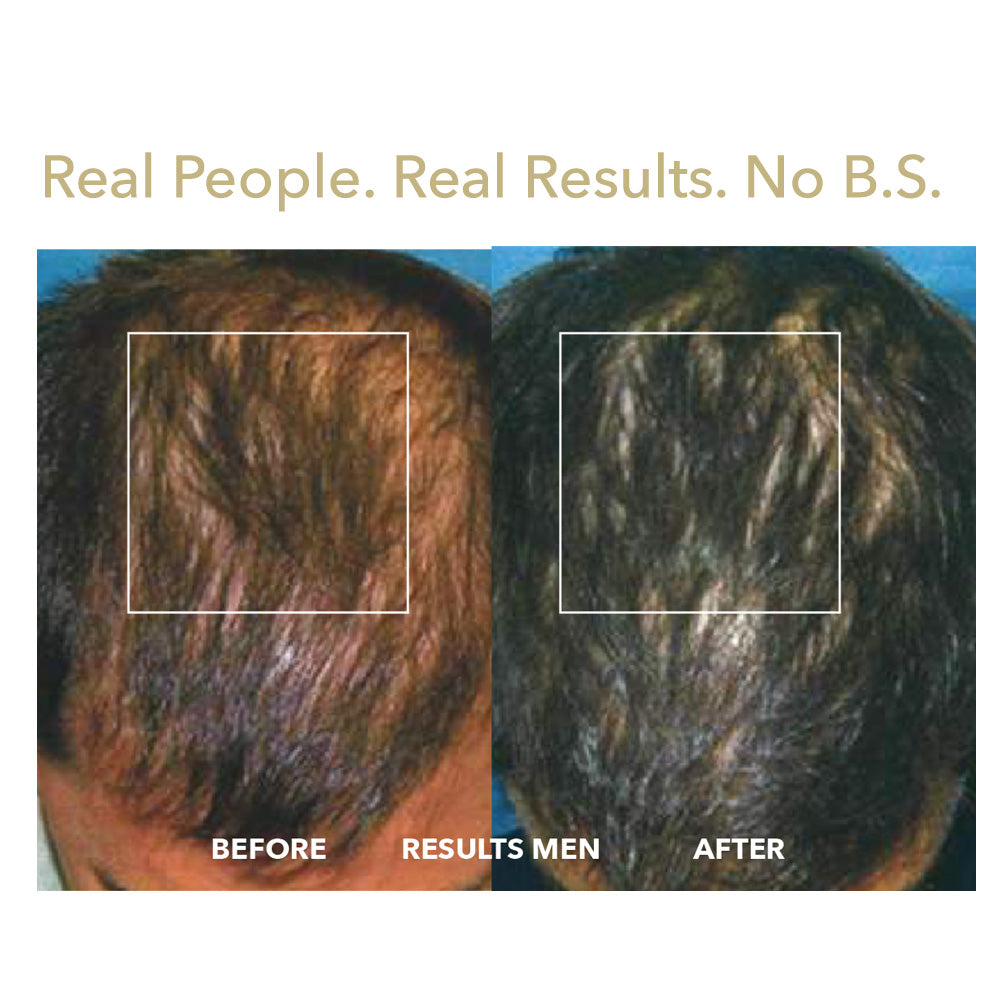 Grow LaserCap: Advanced Laser Hair Regrowth Therapy
